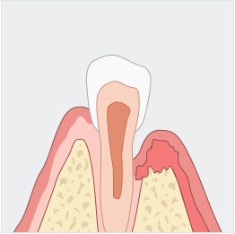 잇몸 일러스트